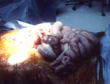Close-up view of edematous bowel. 
