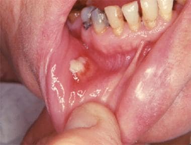 Mouth infection clearance treatment