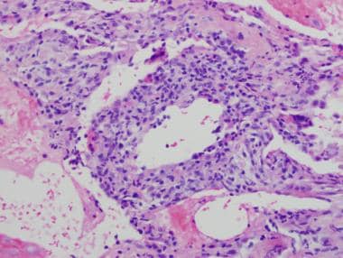 A case of hot tub lung in a 48-year-old woman with