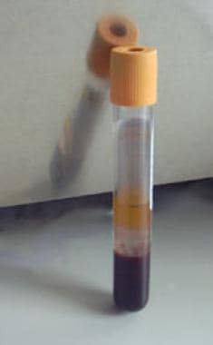 Serum-separator tube. 