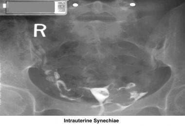 Infertility. Intrauterine synechiae. Image courtes