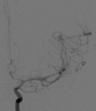 Frontal view from a cerebral angiogram in a 41-yea