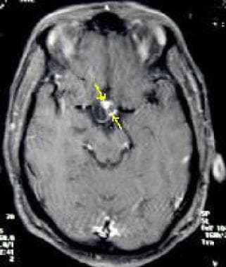 Axial contrast-enhanced T1-weighted MRI demonstrat