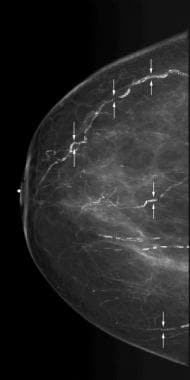 Scattered vascular calcifications with train track