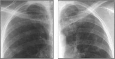 Cystic fibrosis, thoracic. Coned-down views of eac