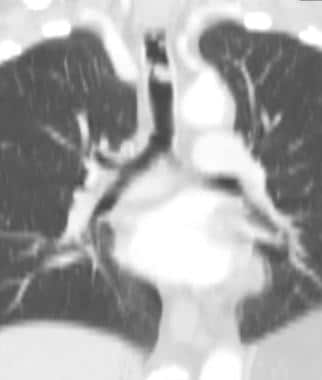 Coronal CT scan shows a large metastatic mass in t