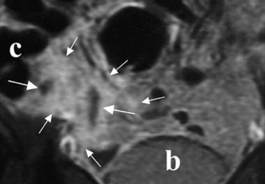 Periappendiceal abscess; contrast-enhanced, fat-su