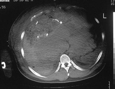 Grade 5 injury in a 36-year-old man who was involv