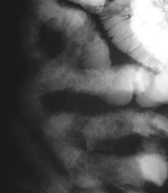 Crohn disease. The radiologic pattern shows cobble