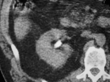 Contrast-enhanced CT section reveals a dense calcu
