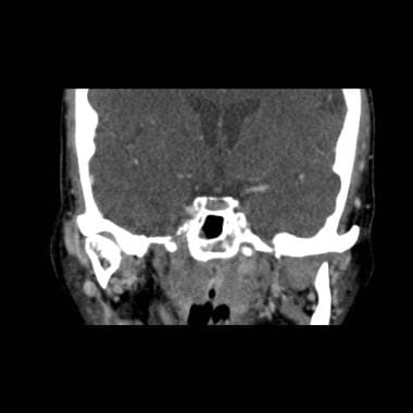 Same patient as in the axial image (56-year-old wo