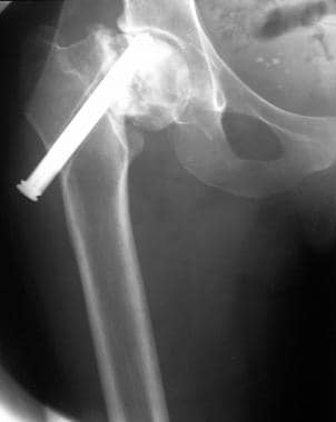 Posttraumatic osteonecrosis of the right femoral h