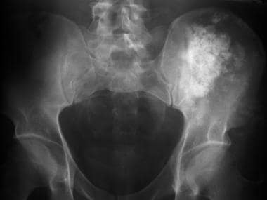 Frontal radiograph of the pelvis demonstrates exte