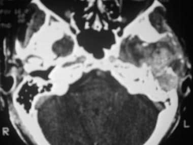 Axial CT scan of the skull base shows a giant cell
