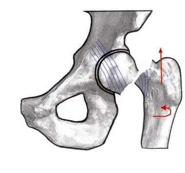 Image depicting a Garden IV hip fracture. 