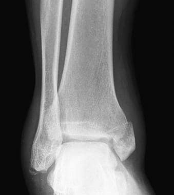 Anteroposterior radiograph from a 37-year-old man 