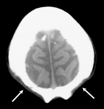 acractaial，非肤色计算断层扫描（CT）S