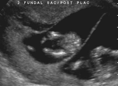 Sagittal endovaginal scan of the uterus in 37-year