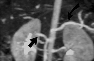 Contrast-enhanced 3-dimensional MR angiogram (grad