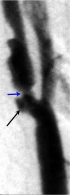 Lateral carotid angiogram in a patient who had a r