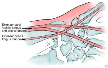 Wrist Arthrocentesis Technique: Aspiration of Wrist Joint, Complications