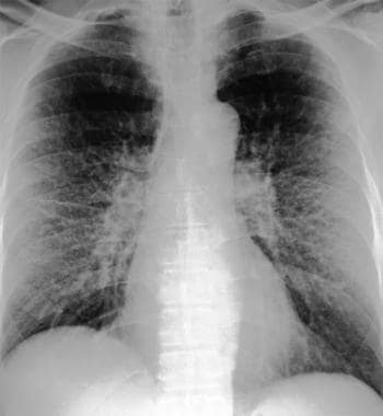 Stage II sarcoidosis. Courtesy of Anthony Notino, 