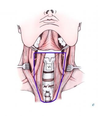 central neck dissection technique