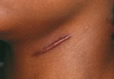 Hypertrophic scarring and keloids. Hypertrophic sc