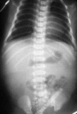 Plain radiograph of duodenal stenosis. 