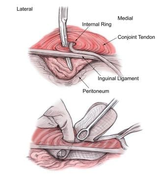 Open inguinal hernia repair (female)