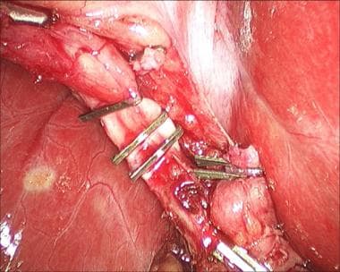 Laparoscopic cholecystectomy. View of clipped cyst