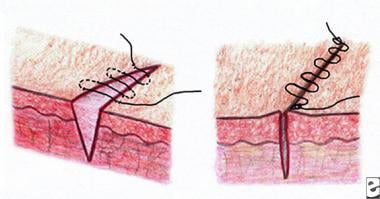 Stitches (Sutures) 101: Overview, Types, Procedures & Removal - Homage