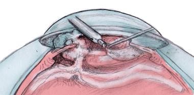 Cataract surgery illustration with ruptured poster
