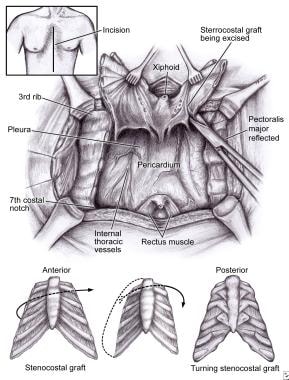 Pectus Excavatum Treatment & Management: Medical Care, Surgical Care ...