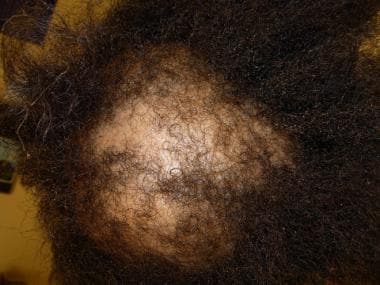 Male-pattern diffuse hair loss. 