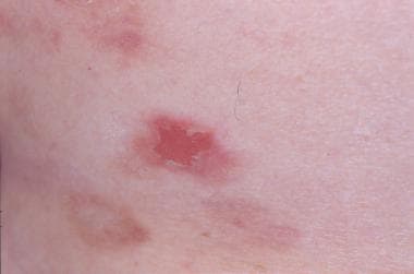 American Journal of Obstetrics & Gynecology - Images in Obstetrics:  Periumbilical blisters: pemphigus vulgaris during pregnancy - Abdominal  skin manifestations of pemphigus vulgaris in a pregnant patient A, Initial  manifestation of erythema