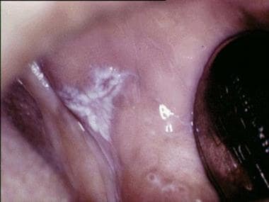 Plaquelike oral lichen planus on the buccal mucosa