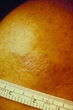 This subtle lesion of cutaneous protothecosis on t