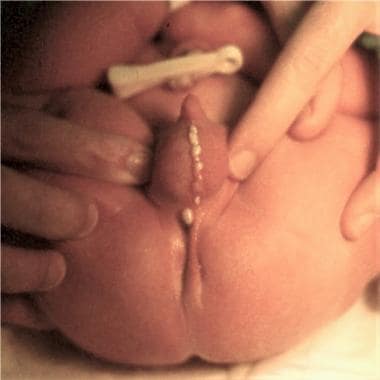 Intestinal obstruction in the newborn. Baby with a