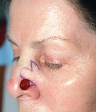 Postoperative Mohs defect over the left nasal side