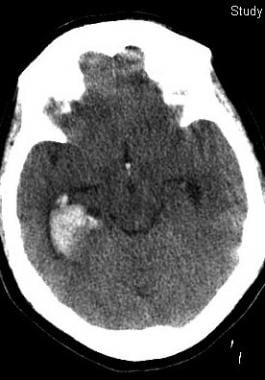 PDF) Microhemorrhage Pathology in Traumatic Brain Injury (TBI): Clinical  and Radiologic Features