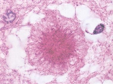 The florid plaque in the cerebral cortex in varian