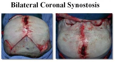 Intraoperative view of bilateral coronal synostosi