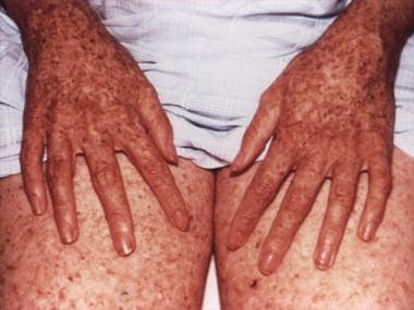 Typical skin manifestation of xeroderma pigmentosu
