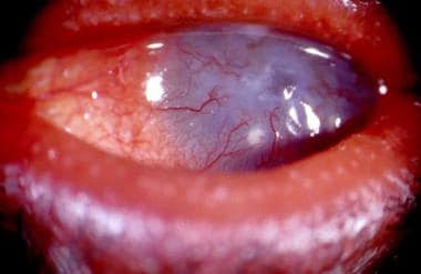 Ocular rosacea. Extensive corneal neovascularizati