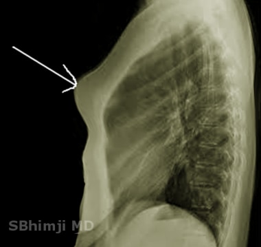 Chest radiography after the Nuss procedure. Four types of bar