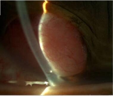 Ciliary body leiomyoma extending anteriorly. 