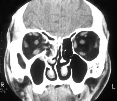 Coronal CT scan of the orbits of a patient with an