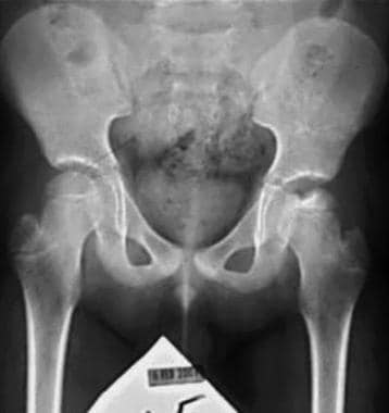 Anteroposterior radiograph from 9-year-old boy wit