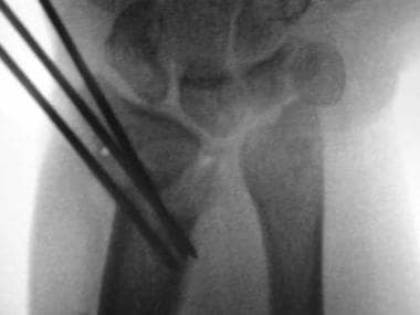 Postoperative posteroanterior radiograph with Kirs